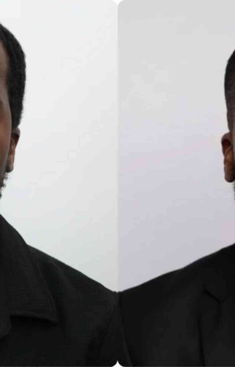 Hair Transplant Turkey